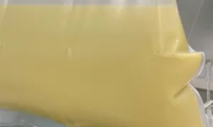 Huyết tương trắng đục như sữa do viêm tụy Huyết tương trắng đục như sữa do viêm tụy