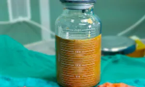 Hơn hai lít chất lỏng lạ trong ngực sau 10 năm tiêm 'mỡ nhân tạo' Hơn hai lít chất lỏng lạ trong ngực sau 10 năm tiêm 'mỡ nhân tạo'