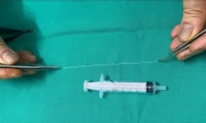 Giun 14 cm sống trong mắt người phụ nữ Giun 14 cm sống trong mắt người phụ nữ