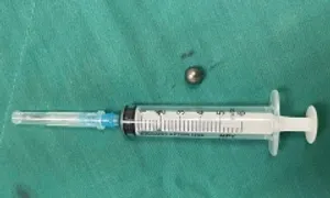 Bé trai 5 tuổi nhập viện cấp cứu vì đạn bi súng đồ chơi Bé trai 5 tuổi nhập viện cấp cứu vì đạn bi súng đồ chơi