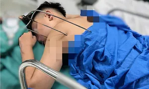 Cứu sống thiếu niên bị chiếc đinh ba đâm thấu tim