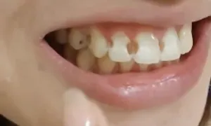 Đeo niềng 5 năm, cô gái phát hiện 8 răng bị thủng lỗ Đeo niềng 5 năm, cô gái phát hiện 8 răng bị thủng lỗ